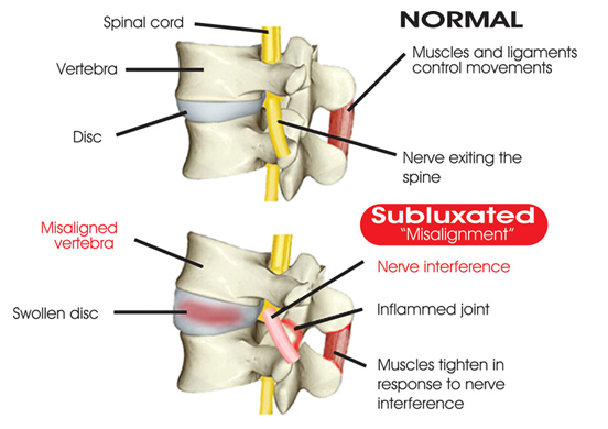 subluxation
nerve interference
where nerves and the spine meet